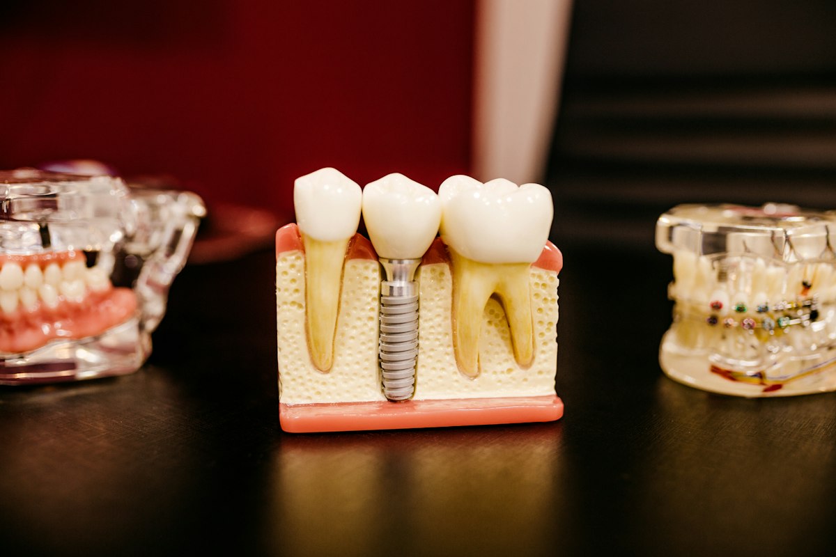 Dental implant model showing tooth replacement